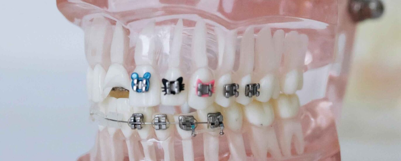 Fixed Braces