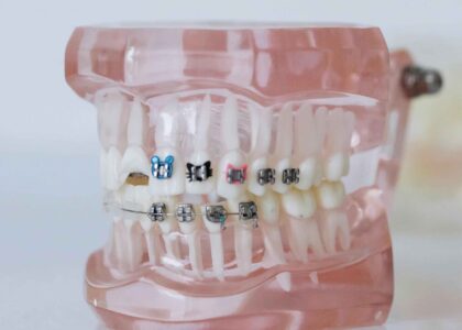 Fixed Braces