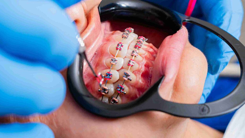 Fixed Braces
